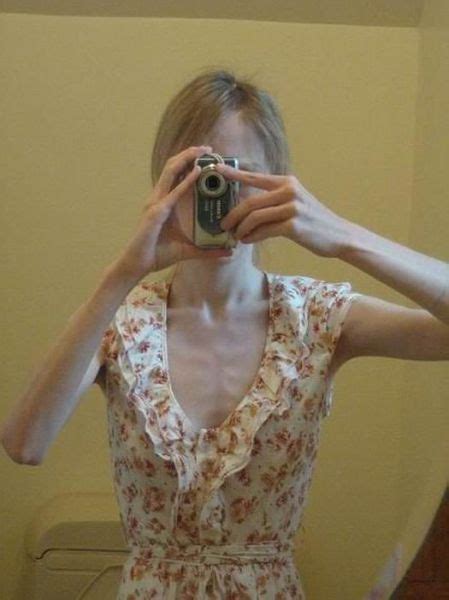 anorexia nudes|Anorexic Tube Search (1784 videos) .